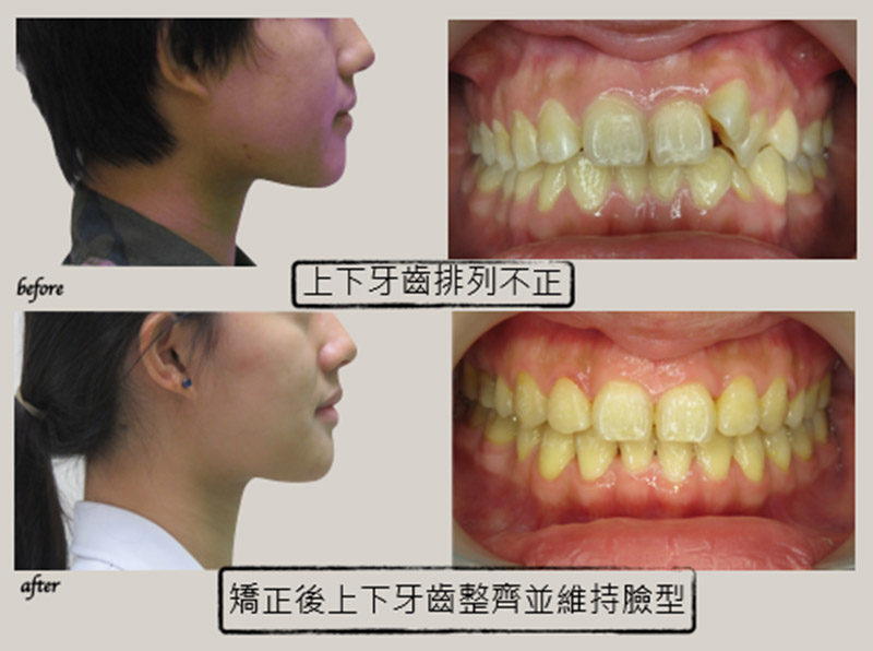 牙齒矯正 牙齒矯正