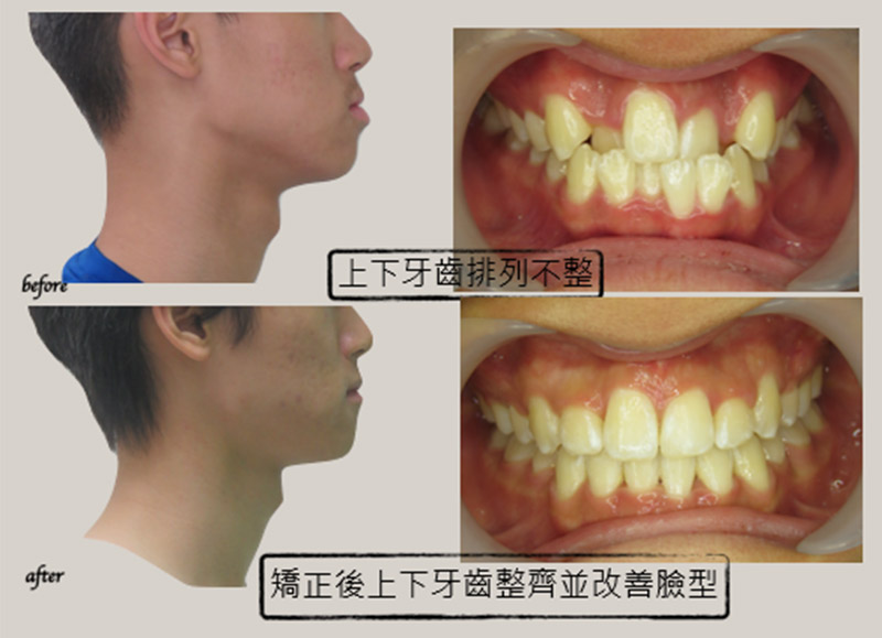 牙齒矯正 牙齒矯正