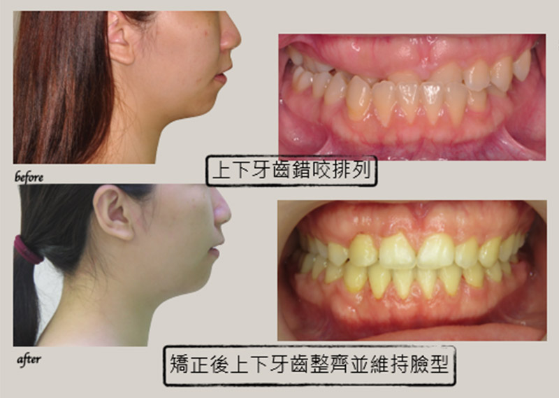 牙齒矯正 牙齒矯正