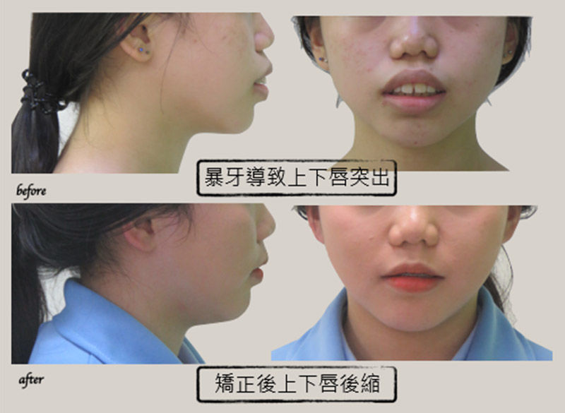 牙齒矯正 牙齒矯正