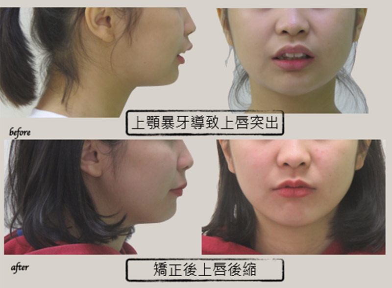 牙齒矯正 牙齒矯正