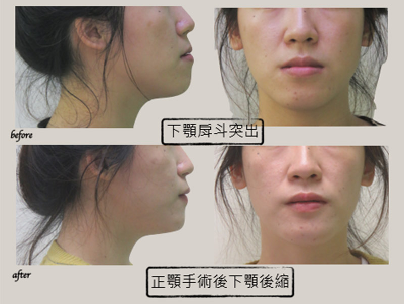 牙齒矯正 牙齒矯正