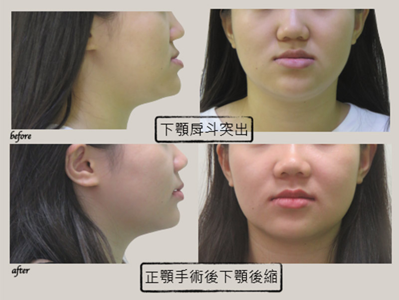 牙齒矯正 牙齒矯正