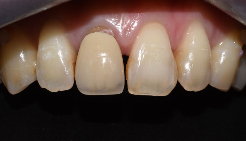 全瓷牙冠/全瓷貼片