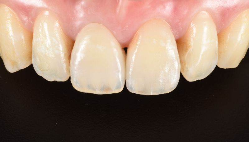 全瓷牙冠/全瓷貼片