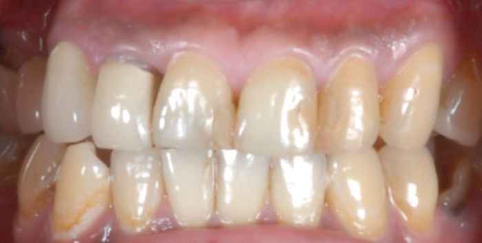 全瓷牙冠/全瓷貼片