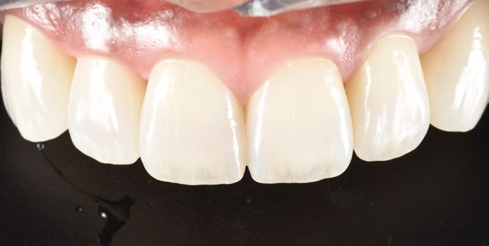 全瓷牙冠/全瓷貼片