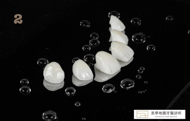 晶透全瓷牙冠 晶透全瓷牙冠