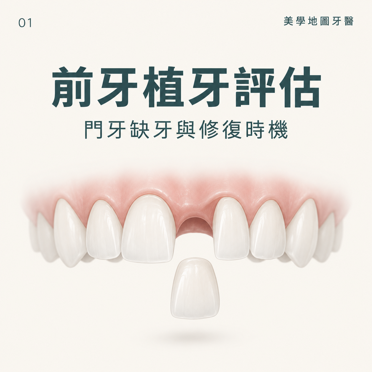 缺牙久了不補怎麼辦?前牙門牙植牙評估與修復時機 缺牙久了不補怎麼辦?前牙門牙植牙評估與修復時機