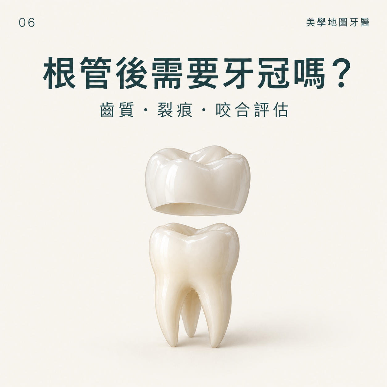 根管治療後一定要做牙冠嗎？剩餘齒質、裂痕與咬合是評估關鍵