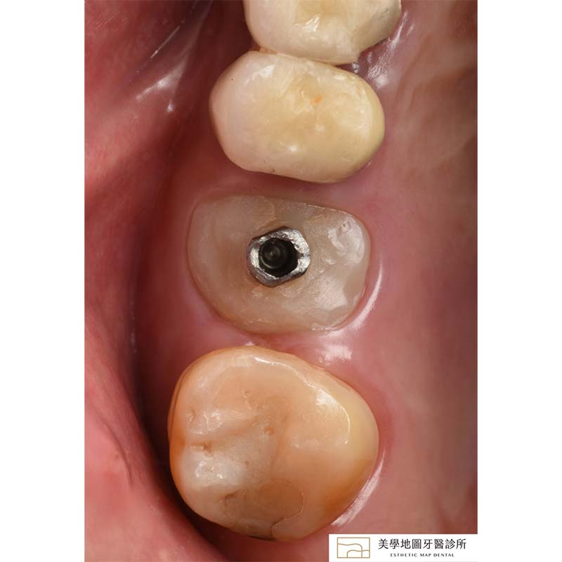 補骨治療 補骨治療